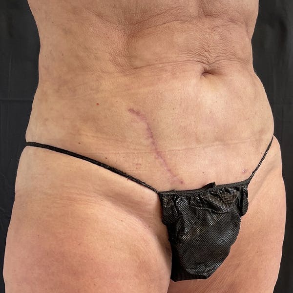  Scar Revision Before & After Gallery - Patient 122404176 - Image 2