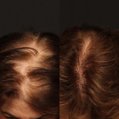 Hair Restoration Before & After Gallery - Patient 142814057 - Image 1