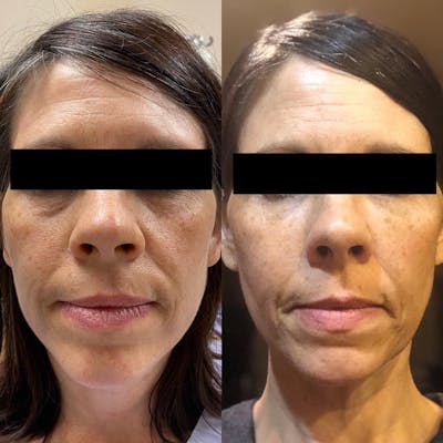 Facial Fat Transfer  Before & After Gallery - Patient 142814068 - Image 1