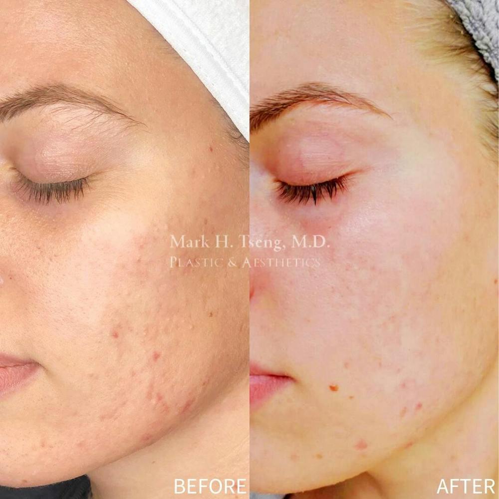 Chemical Peels Before & After Gallery - Patient 142814080 - Image 1
