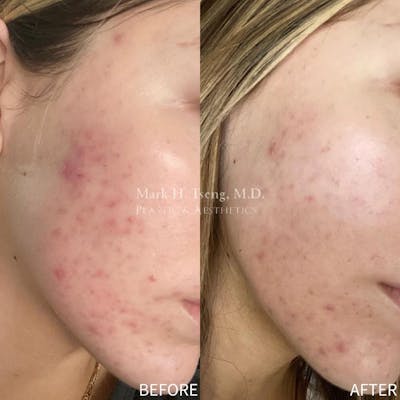 Chemical Peels Before & After Gallery - Patient 142814091 - Image 1