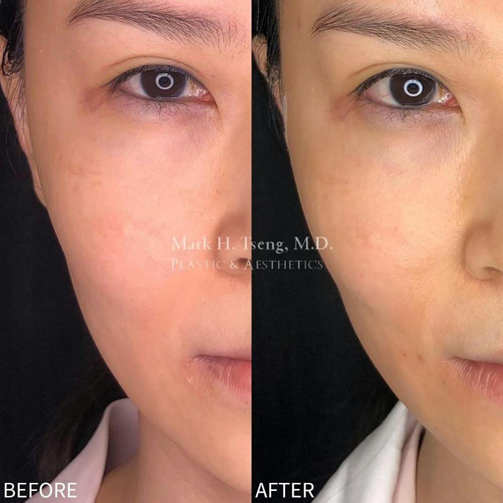 Non-Surgical Facelift Before & After Gallery - Patient 142814101 - Image 1