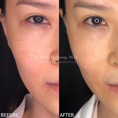 Non-Surgical Facelift Before & After Gallery - Patient 142814101 - Image 1