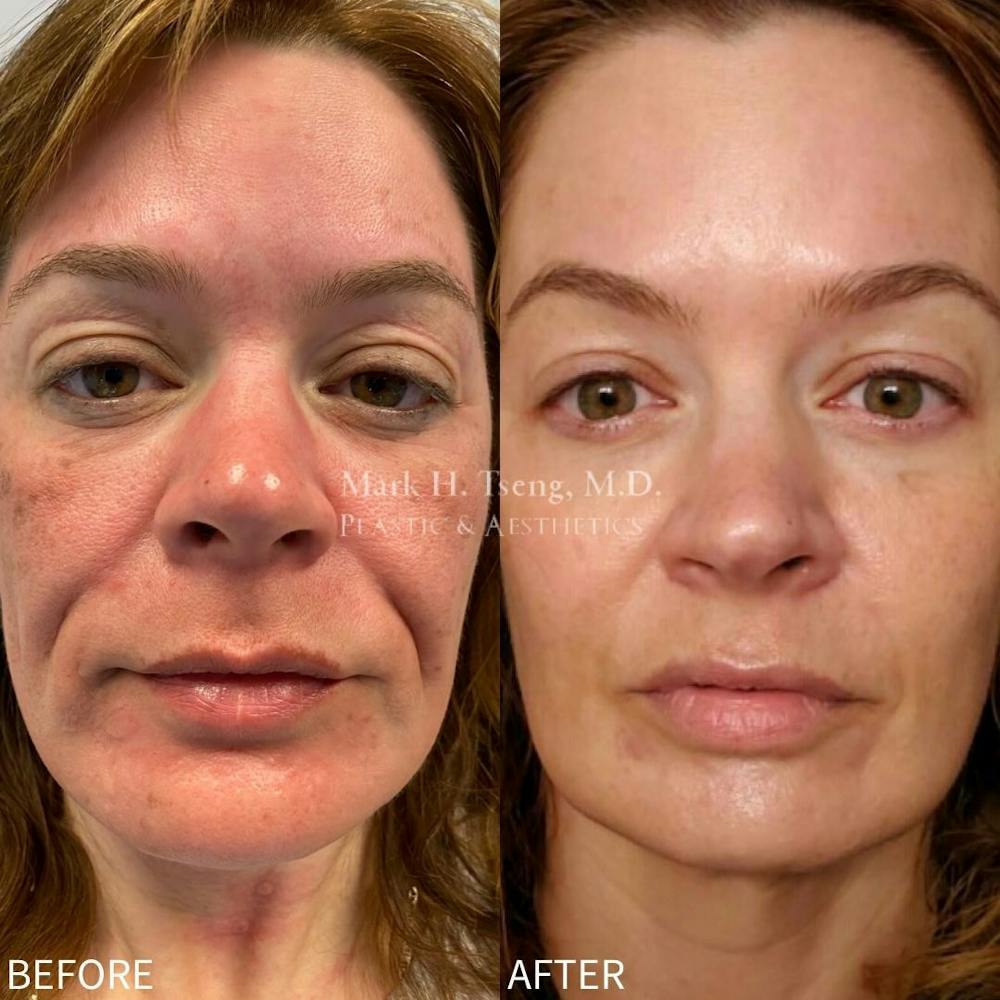 PicoWay Before & After Gallery - Patient 42746363 - Image 1