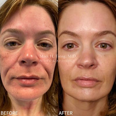 PicoWay Before & After Gallery - Patient 42746363 - Image 1