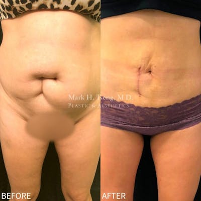 Abdomen Liposuction Before & After Gallery - Patient 146990031 - Image 1