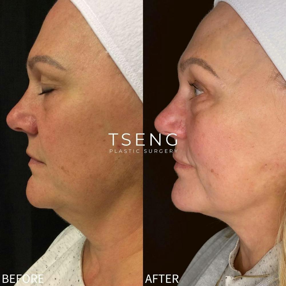 Chin Liposuction Before & After Gallery - Patient 146990047 - Image 1