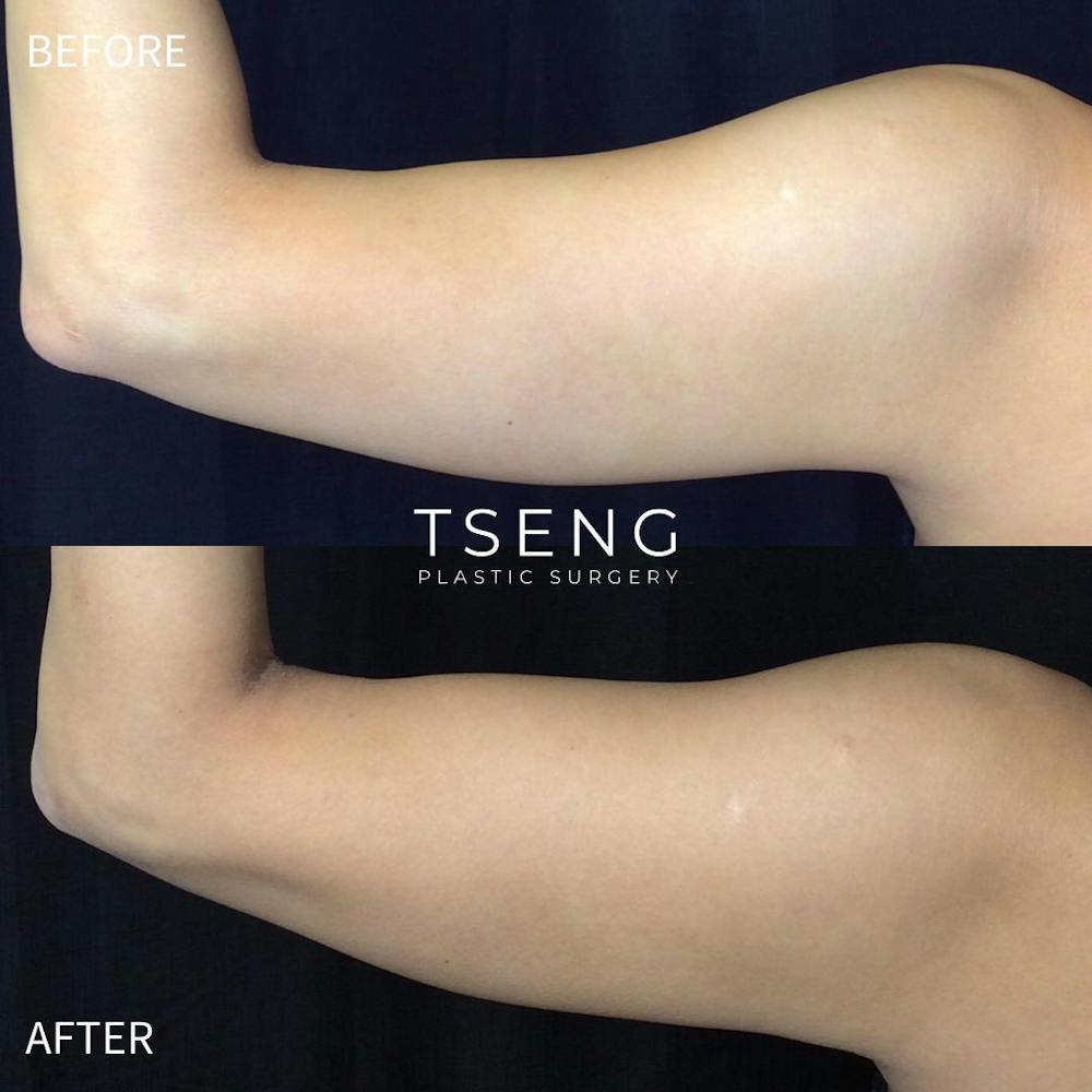 EmSculpt Before & After Gallery - Patient 42746317 - Image 1