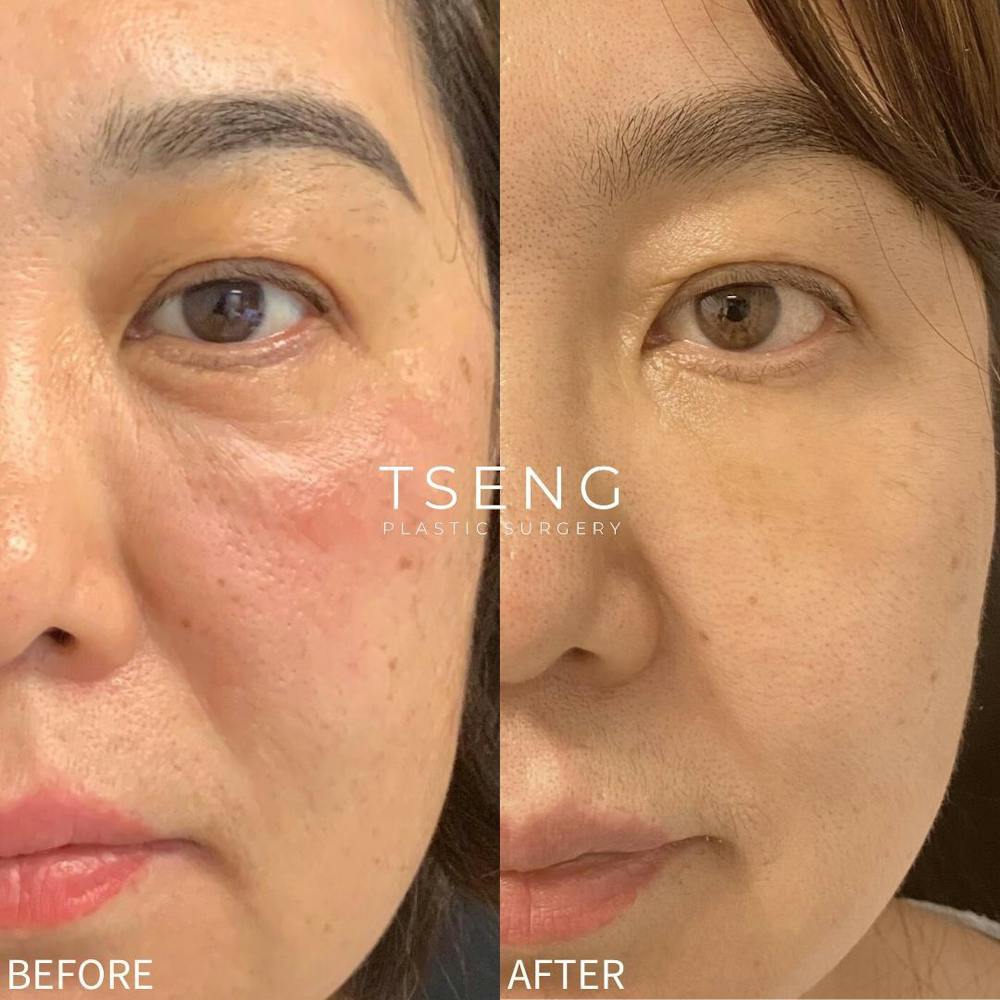 Facial Fat Transfer  Before & After Gallery - Patient 142814130 - Image 1
