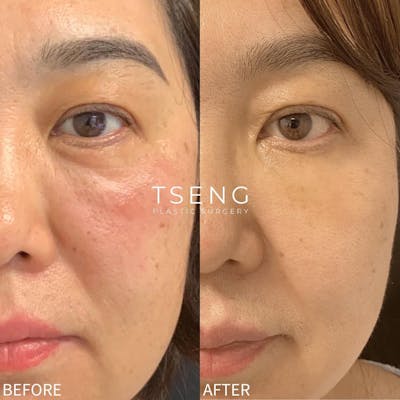 Facial Fat Transfer  Before & After Gallery - Patient 142814130 - Image 1