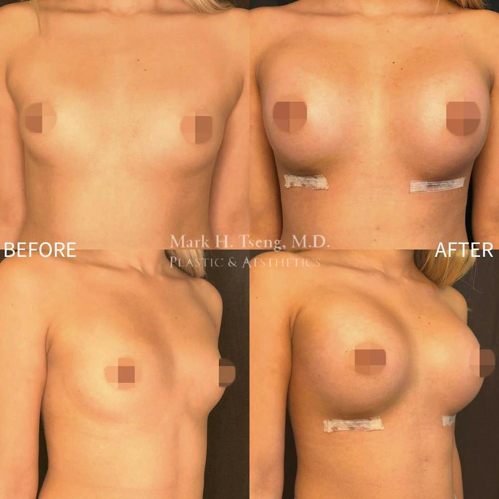 Breast Augmentation Before & After Gallery - Patient 142814134 - Image 1