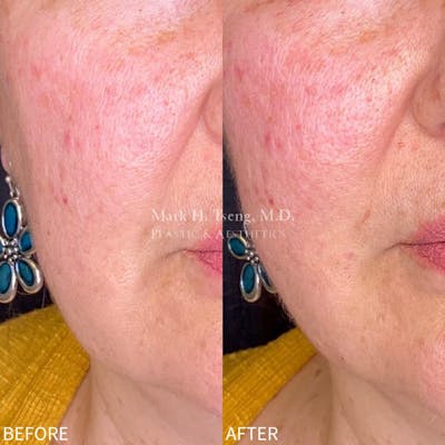 Non-Surgical Facelift Before & After Gallery - Patient 142814138 - Image 1
