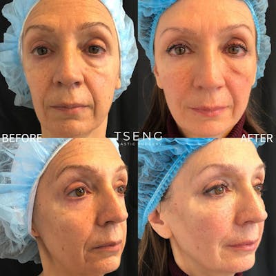 Facial Fat Transfer  Before & After Gallery - Patient 42746296 - Image 1