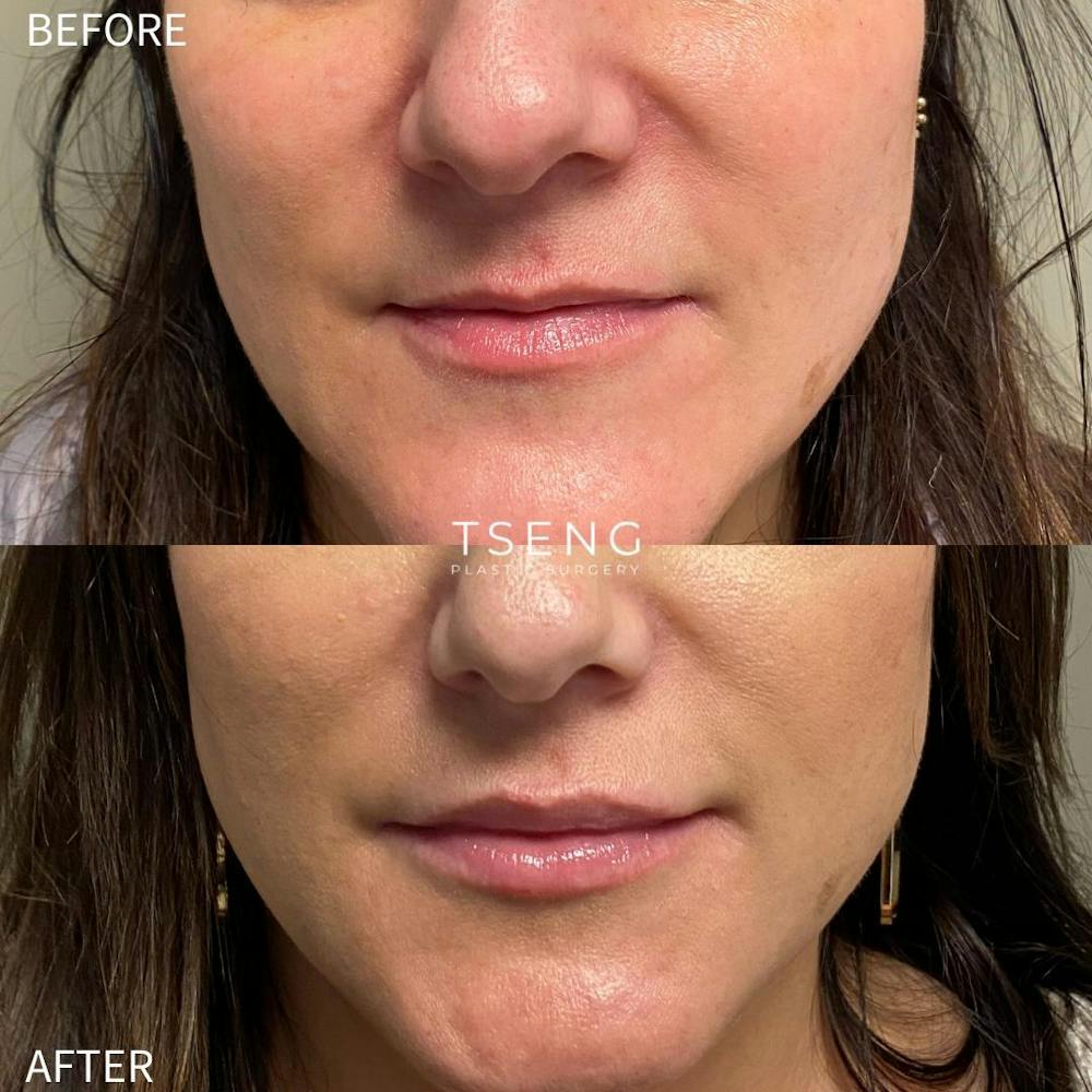 Dermal Fillers Before & After Gallery - Patient 142814155 - Image 1