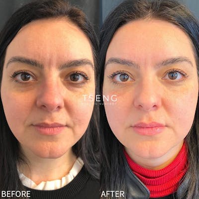 Dermal Fillers Before & After Gallery - Patient 142814163 - Image 1