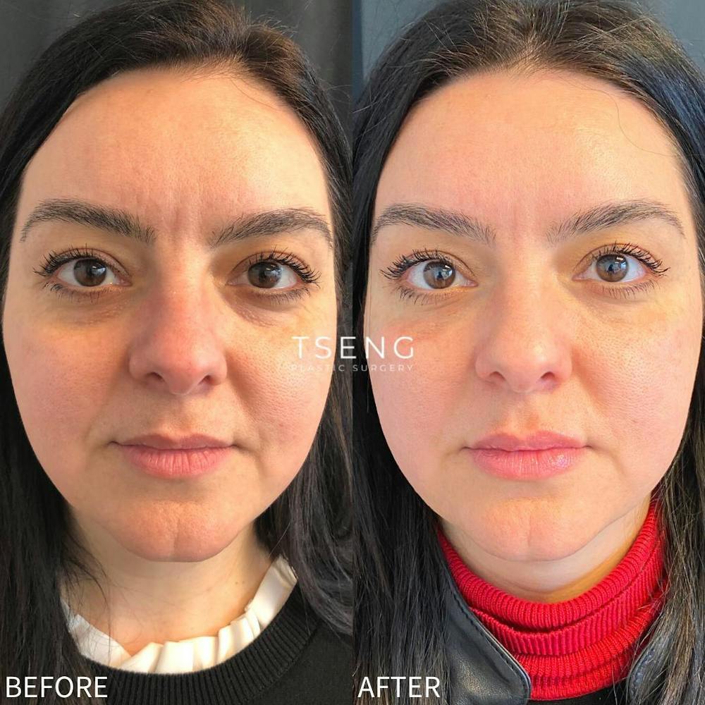 Dermal Fillers Before & After Gallery - Patient 142814163 - Image 1