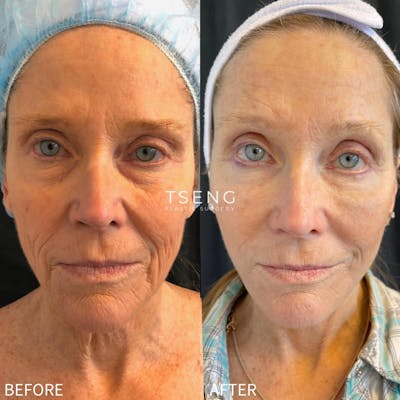 Facelift Before & After Gallery - Patient 42746279 - Image 1