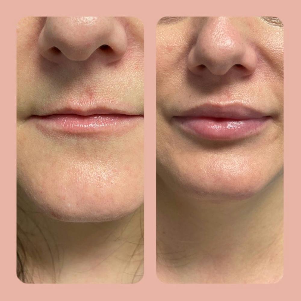 Dermal Fillers Before & After Gallery - Patient 142814169 - Image 1