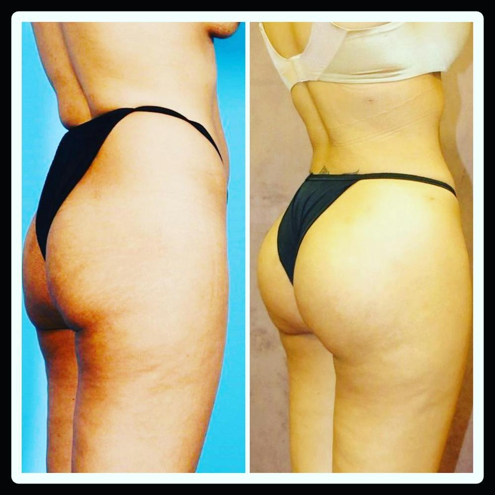 Brazilian Butt Lift Before & After Gallery - Patient 142814173 - Image 1