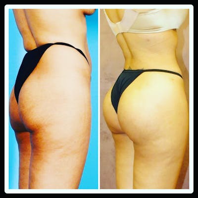 Brazilian Butt Lift Before & After Gallery - Patient 142814173 - Image 1