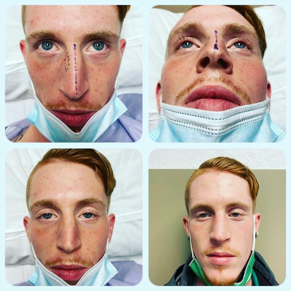 Rhinoplasty Before & After Gallery - Patient 142814175 - Image 1