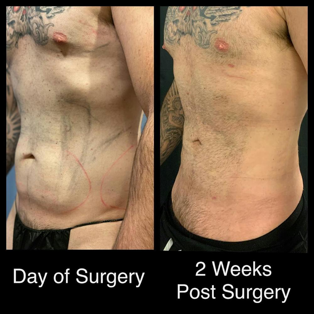 Abdomen Liposuction Before & After Gallery - Patient 146990075 - Image 1