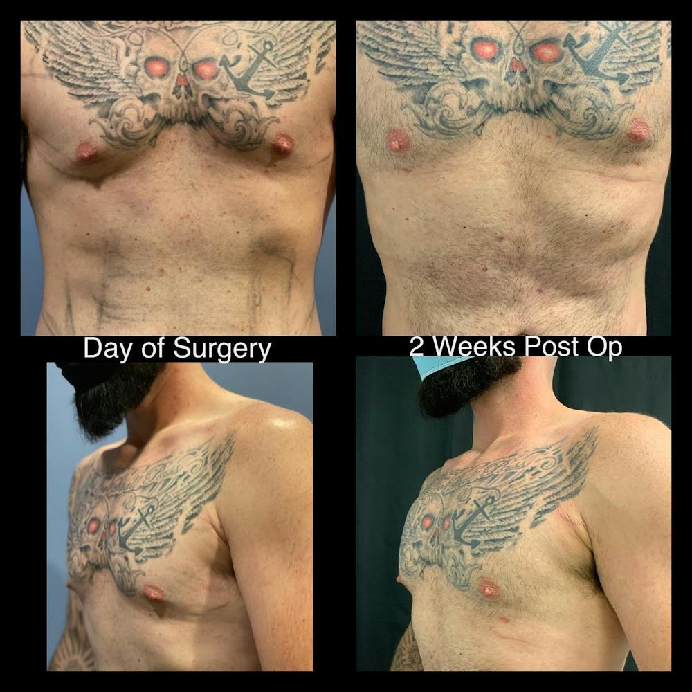 Abdomen Liposuction Before & After Gallery - Patient 146990075 - Image 2