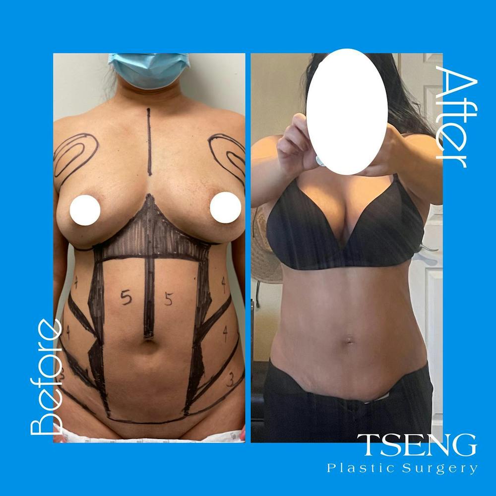HD Body Sculpting Before & After Gallery - Patient 142814208 - Image 1