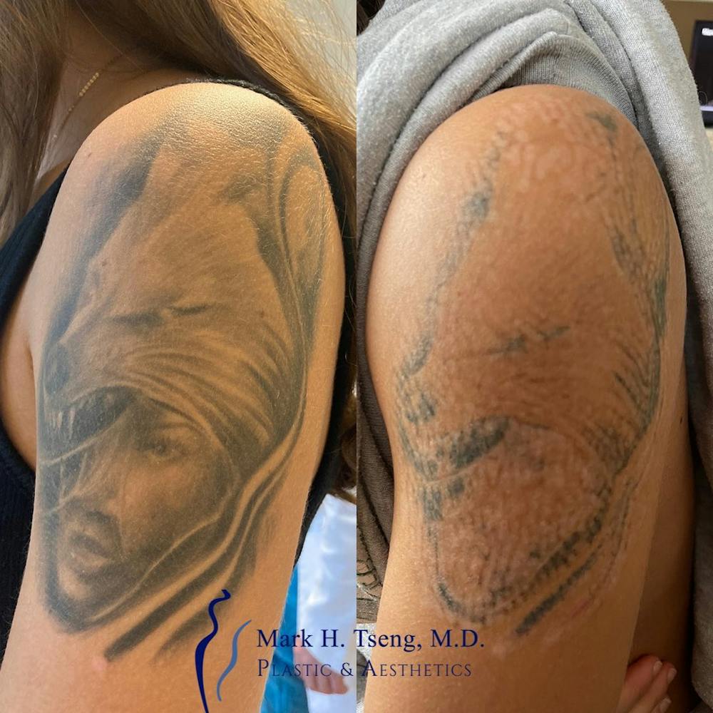 Laser Tattoo Removal Before & After Gallery - Patient 142814237 - Image 1