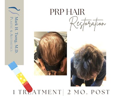 Hair Restoration Before & After Gallery - Patient 142814254 - Image 1