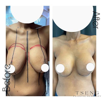 Breast Lift (Mastopexy) Before & After Gallery - Patient 142814257 - Image 1