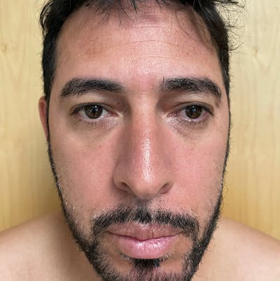 Facial Fat Transfer  Before & After Gallery - Patient 143364567 - Image 1