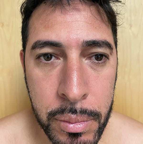 Facelift Before & After Gallery - Patient 143364562 - Image 1