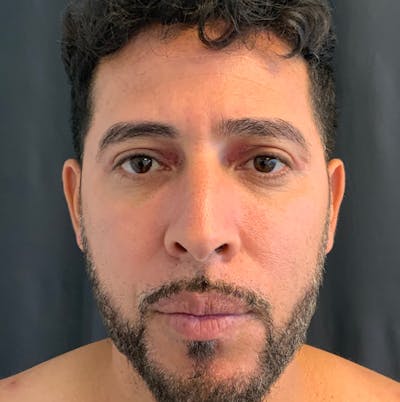Facelift Before & After Gallery - Patient 143364562 - Image 2