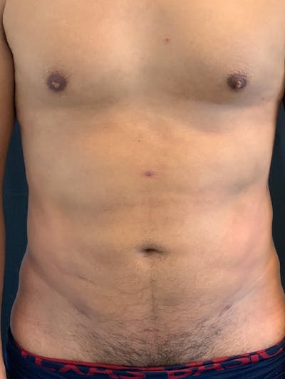 HD Body Sculpting Before & After Gallery - Patient 143364597 - Image 2