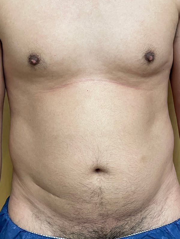 Abdomen Liposuction Before & After Gallery - Patient 146990204 - Image 1