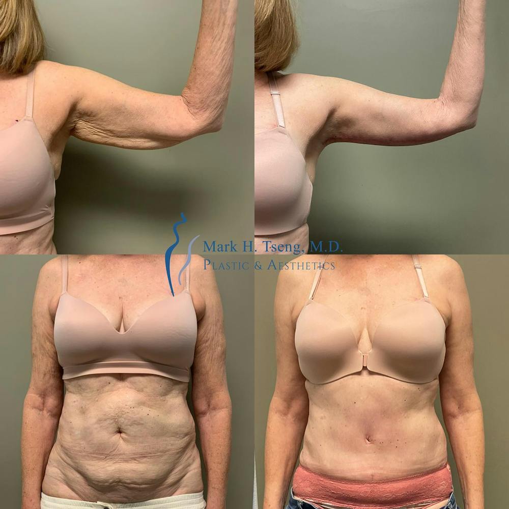 Tummy Tuck (Abdominoplasty)  Before & After Gallery - Patient 143528806 - Image 1