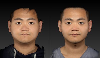 Renuvion Before & After Gallery - Patient 143531449 - Image 1