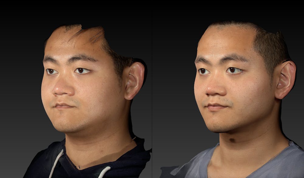 Renuvion Before & After Gallery - Patient 143531449 - Image 2