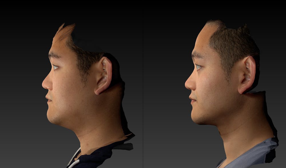 Renuvion Before & After Gallery - Patient 143531449 - Image 3