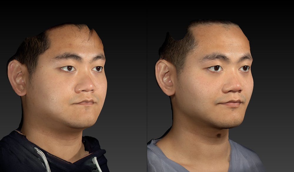 Renuvion Before & After Gallery - Patient 143531449 - Image 4
