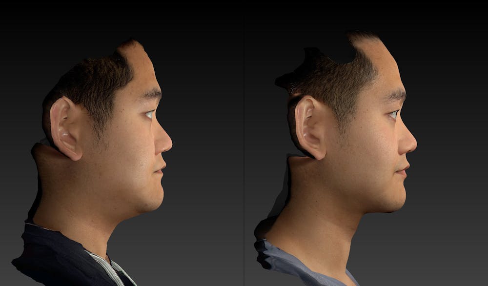 Renuvion Before & After Gallery - Patient 143531449 - Image 5