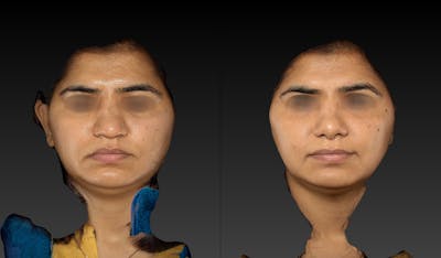 Rhinoplasty Before & After Gallery - Patient 143531493 - Image 1