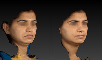 Rhinoplasty Before & After Gallery - Patient 143531493 - Image 2