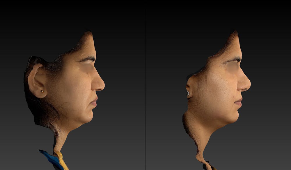 Rhinoplasty Before & After Gallery - Patient 143531493 - Image 3