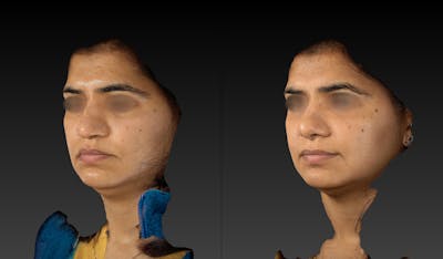 Rhinoplasty Before & After Gallery - Patient 143531493 - Image 4