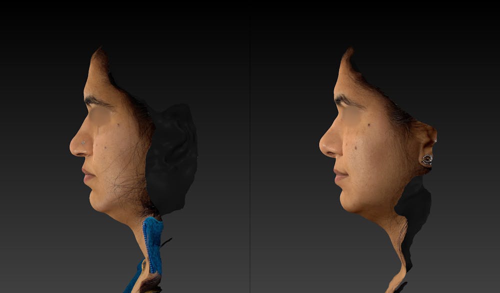 Rhinoplasty Before & After Gallery - Patient 143531493 - Image 5