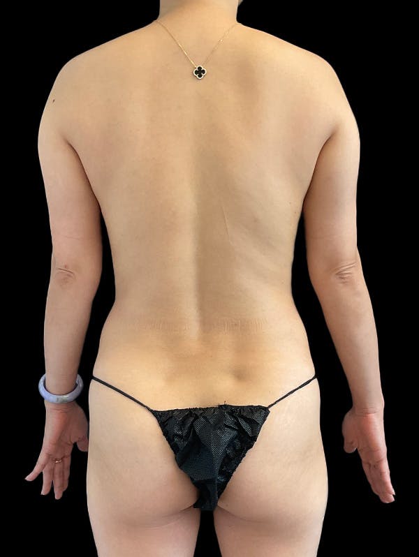 Abdomen Liposuction Before & After Gallery - Patient 146990195 - Image 5