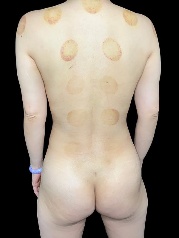 Abdomen Liposuction Before & After Gallery - Patient 146990195 - Image 6