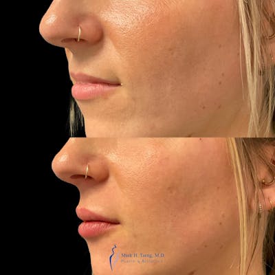 Lip Fillers Before & After Gallery - Patient 146225275 - Image 1